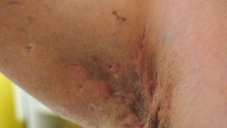 HidradenitisSuppurativaWEB-1200x800