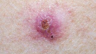 Basal,Cell,Carcinoma