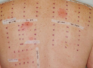 Module 7: Patch Test Interpretation and Patient Education