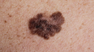 Melanoma
