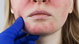 Rosacea (2)