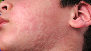 urticaria